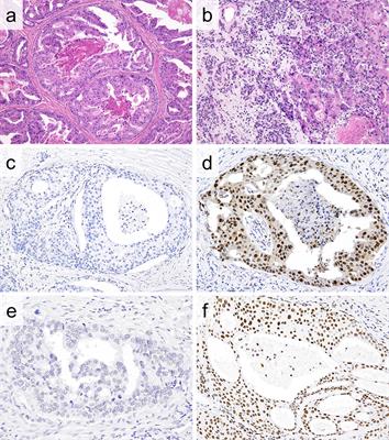 The Role of the EZH2 and H3K27me3 Expression as a Predictor of Clinical Outcomes in Salivary Duct Carcinoma Patients: A Large-Series Study With Emphasis on the Relevance to the Combined Androgen Blockade and HER2-Targeted Therapy